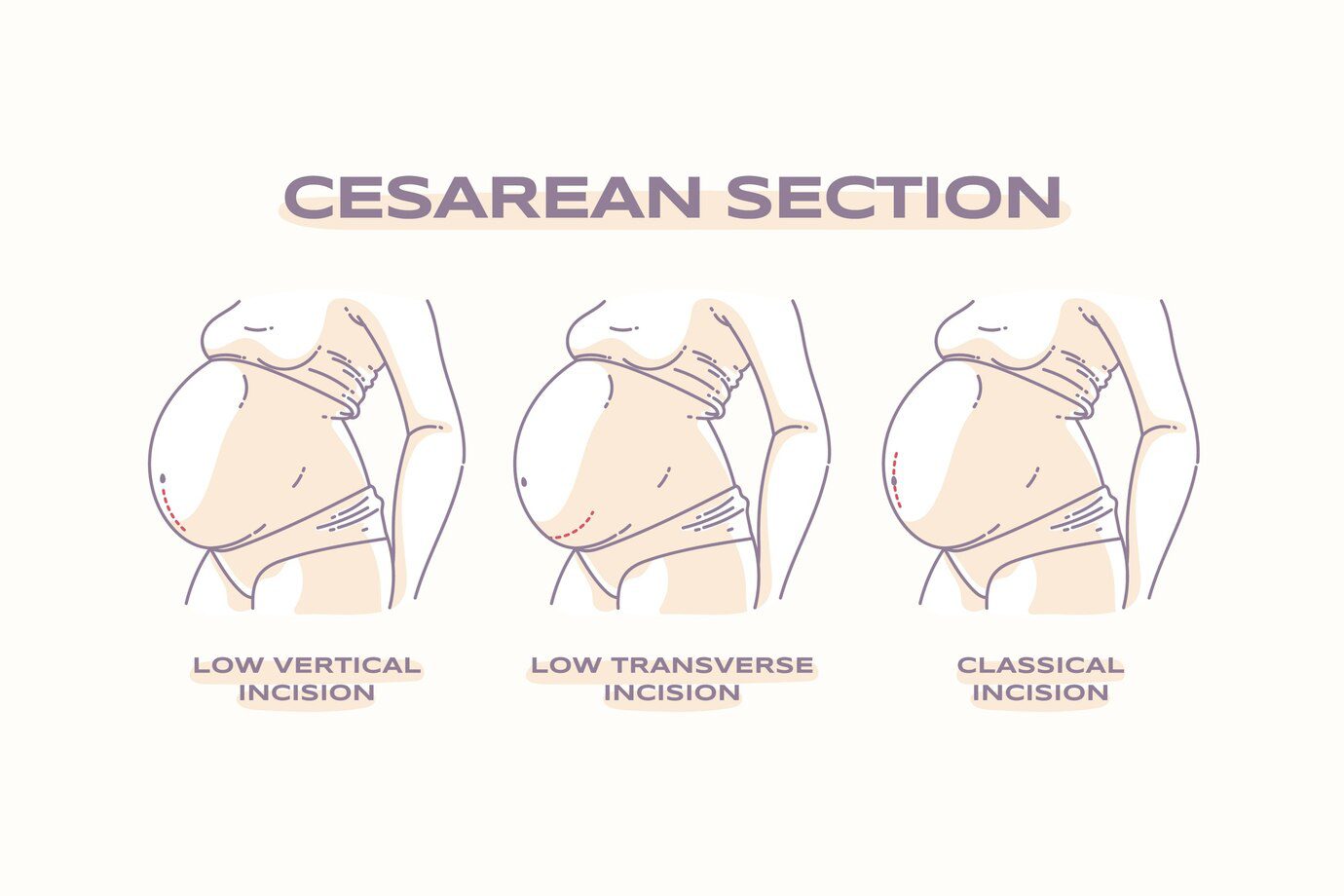 Recuperación de cesárea en Zaragoza