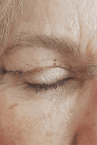 Fisioterapia Postquirúrgica después de una Cirugía Estética